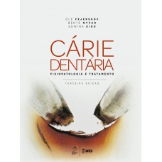 Cárie dentária: fisiopatologia e tratamento Cárie dentária: fisiopatologia e tratamento