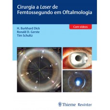 Cirurgia a Laser de Femtossegundo em Oftalmologia Cirurgia a Laser de Femtossegundo em Oftalmologia
